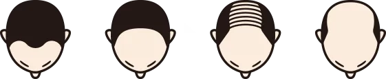 前頭部から薄毛が進行していくイメージ